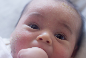baby mit milchschorf im gesicht