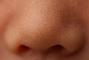 baby mit talgdruesenhyperplasie an der nase